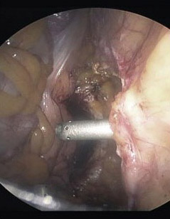 prostatectomia_radical_laparoscopica/colocacion_quinto_trocar