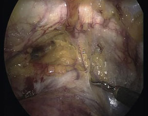 prostatectomia_radical_laparoscopica/desarrollo_espacio_Retzius