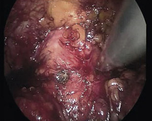 prostatectomia_radical_laparoscopica/identificacion_cuello_vesical