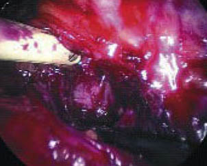 prostatectomia_radical_laparoscopica/liberacion_cuello_vesical