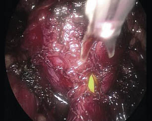 prostatectomia_radical_laparoscopica/seccion_cuello_vesical