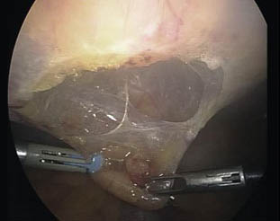 prostatectomia_radical_laparoscopica/seccion_uraco