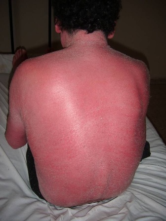 psoriasis_eritrodermica_caso/espalda_paciente_psoriasis psoriasis_eritrodermica_caso/espalda_paciente_psoriasis