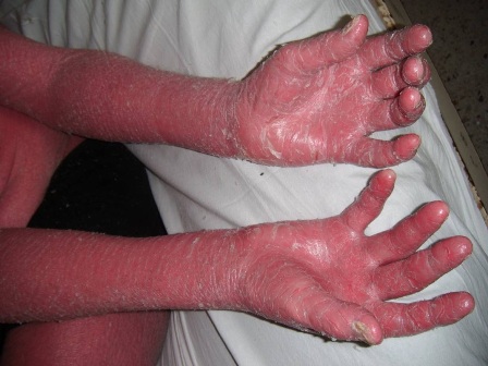 psoriasis_eritrodermica_caso/manos_paciente_psoriasis psoriasis_eritrodermica_caso/manos_paciente_psoriasis