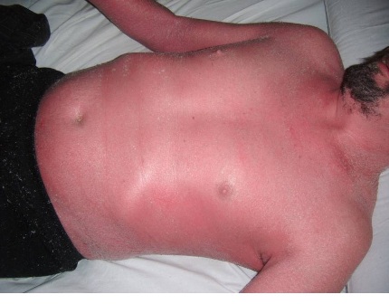 psoriasis_eritrodermica_caso/pecho_paciente_psoriasis psoriasis_eritrodermica_caso/pecho_paciente_psoriasis