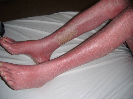 psoriasis_eritrodermica_caso/piernas_paciente_psoriasis psoriasis_eritrodermica_caso/piernas_paciente_psoriasis