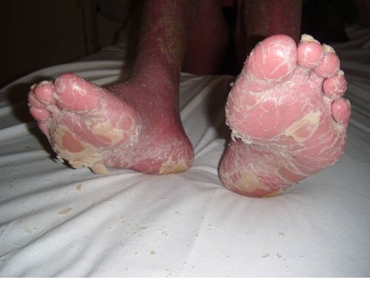 psoriasis_eritrodermica_caso/pies_paciente_psoriasis psoriasis_eritrodermica_caso/pies_paciente_psoriasis