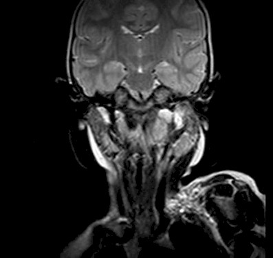 torticolis_no_traumatica/RMN_absceso_parafaringeo