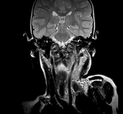 torticolis_no_traumatica/RMN_absceso_retrofaringeo torticolis_no_traumatica/RMN_absceso_retrofaringeo