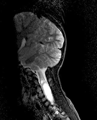 torticolis_no_traumatica/RMN_engrosamiento_medular