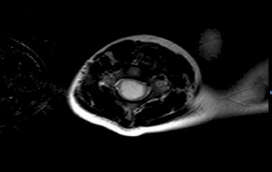 torticolis_no_traumatica/RMN_engrosamiento_medular_C5