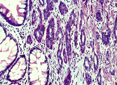 tumor_carcinoide_apendice/biopsia_carcinoides_1 tumor_carcinoide_apendice/biopsia_carcinoides_1