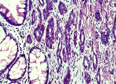 tumor_carcinoide_apendice/biopsia_carcinoides_1