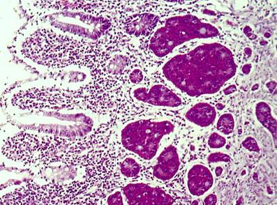tumor_carcinoide_apendice/biopsia_carcinoides_2 tumor_carcinoide_apendice/biopsia_carcinoides_2