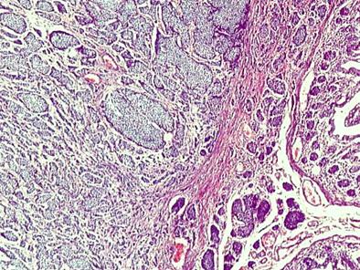 tumor_carcinoide_apendice/biopsia_carcinoides_3 tumor_carcinoide_apendice/biopsia_carcinoides_3