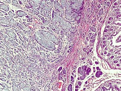 tumor_carcinoide_apendice/biopsia_carcinoides_3