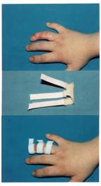 aplicaciones_tecnologia_termoplastica/clinodactilia_mano aplicaciones_tecnologia_termoplastica/clinodactilia_mano