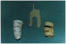 aplicaciones_tecnologia_termoplastica/clinodactilia_moderada_1