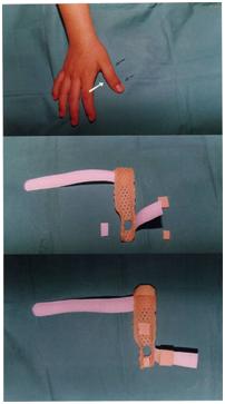 aplicaciones_tecnologia_termoplastica/clinodactilia_pulgar_derecho_1 aplicaciones_tecnologia_termoplastica/clinodactilia_pulgar_derecho_1