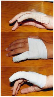 aplicaciones_tecnologia_termoplastica/contusion_IF