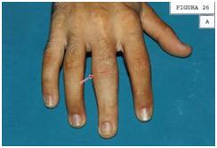 aplicaciones_tecnologia_termoplastica/contusion_IFP_1 aplicaciones_tecnologia_termoplastica/contusion_IFP_1