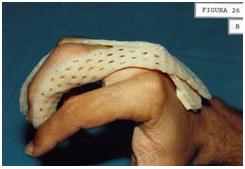 aplicaciones_tecnologia_termoplastica/contusion_IFP_3 aplicaciones_tecnologia_termoplastica/contusion_IFP_3
