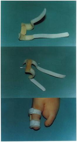 aplicaciones_tecnologia_termoplastica/ectrodactilia_ortesis_4