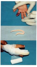 aplicaciones_tecnologia_termoplastica/herida_cara_palmar aplicaciones_tecnologia_termoplastica/herida_cara_palmar