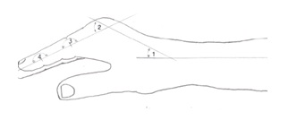 aplicaciones_tecnologia_termoplastica/inmovilizacion_mano_quemada