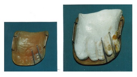 aplicaciones_tecnologia_termoplastica/ortesis_no_dental aplicaciones_tecnologia_termoplastica/ortesis_no_dental