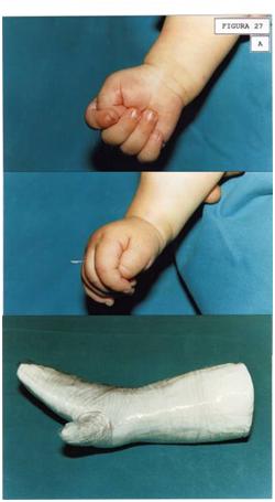 aplicaciones_tecnologia_termoplastica/pulgar_oposicion_permanente_1 aplicaciones_tecnologia_termoplastica/pulgar_oposicion_permanente_1