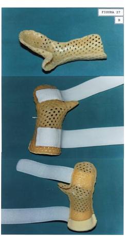 aplicaciones_tecnologia_termoplastica/pulgar_oposicion_permanente_2 aplicaciones_tecnologia_termoplastica/pulgar_oposicion_permanente_2