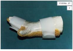 caciones_tecnologia_termoplastica/pulgar_oposicion_permanente_3 caciones_tecnologia_termoplastica/pulgar_oposicion_permanente_3