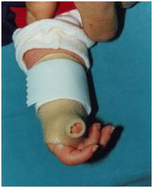aplicaciones_tecnologia_termoplastica/pulgar_palma_bilateral_11 aplicaciones_tecnologia_termoplastica/pulgar_palma_bilateral_11