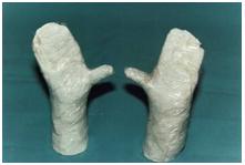 aplicaciones_tecnologia_termoplastica/pulgar_palma_bilateral_4