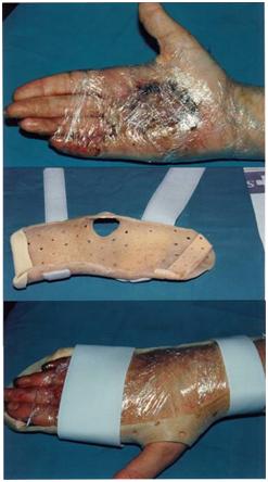 aplicaciones_tecnologia_termoplastica/quemadura_palmar_injertada