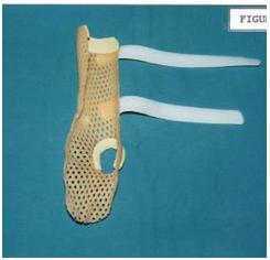 aplicaciones_tecnologia_termoplastica/seccion_cubital_derecho_ortesis_1