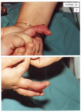 aplicaciones_tecnologia_termoplastica/seccion_tendon_extensor_1 aplicaciones_tecnologia_termoplastica/seccion_tendon_extensor_1
