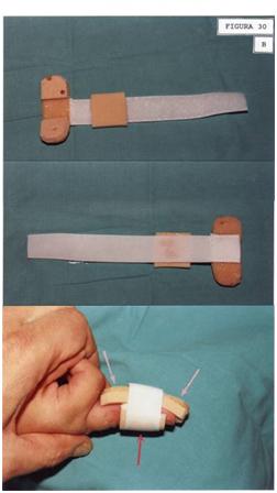 aplicaciones_tecnologia_termoplastica/seccion_tendon_extensor_2 aplicaciones_tecnologia_termoplastica/seccion_tendon_extensor_2