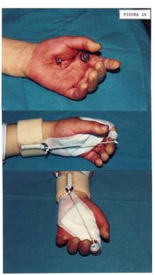 aplicaciones_tecnologia_termoplastica/seccion_tendon_flexor aplicaciones_tecnologia_termoplastica/seccion_tendon_flexor