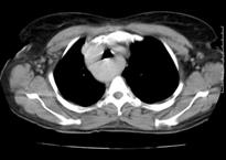 arco_aortico_caso_clinico/figura_3 arco_aortico_caso_clinico/figura_3