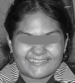 carcinoma_quistico_parotida/asimetria_facial_POP carcinoma_quistico_parotida/asimetria_facial_POP