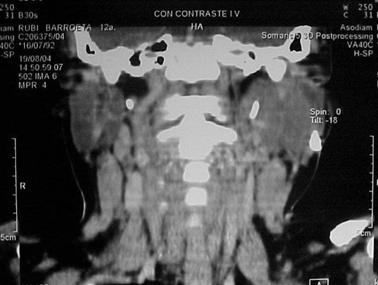 carcinoma_quistico_parotida/tm_parotideo_TAC_coronal carcinoma_quistico_parotida/tm_parotideo_TAC_coronal