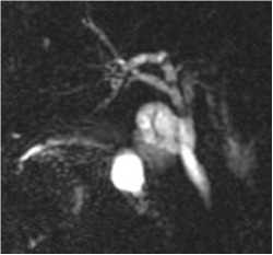 cirugia_pancreatitis_cronica/CPRM_ pancreatitis_cronica