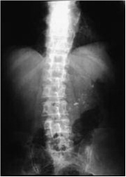 cirugia_pancreatitis_cronica/Rx_abdomen cirugia_pancreatitis_cronica/Rx_abdomen
