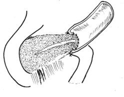 cirugia_pancreatitis_cronica/anastomosis_yeyumo