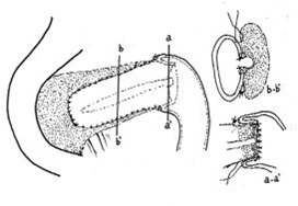 cirugia_pancreatitis_cronica/disposicion_puntos_sutura