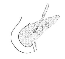 cirugia_pancreatitis_cronica/extraccion_calculos_intracanaliculares