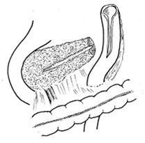 cirugia_pancreatitis_cronica/operacion_Puestow_Gillesby