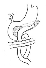 cirugia_pancreatitis_cronica/operacion_puestow_terminada cirugia_pancreatitis_cronica/operacion_puestow_terminada
